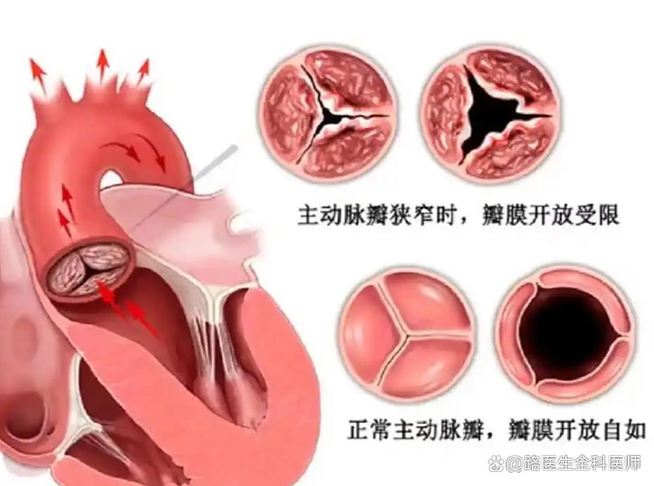人工心脏瓣膜未来将如何突破技术瓶颈?